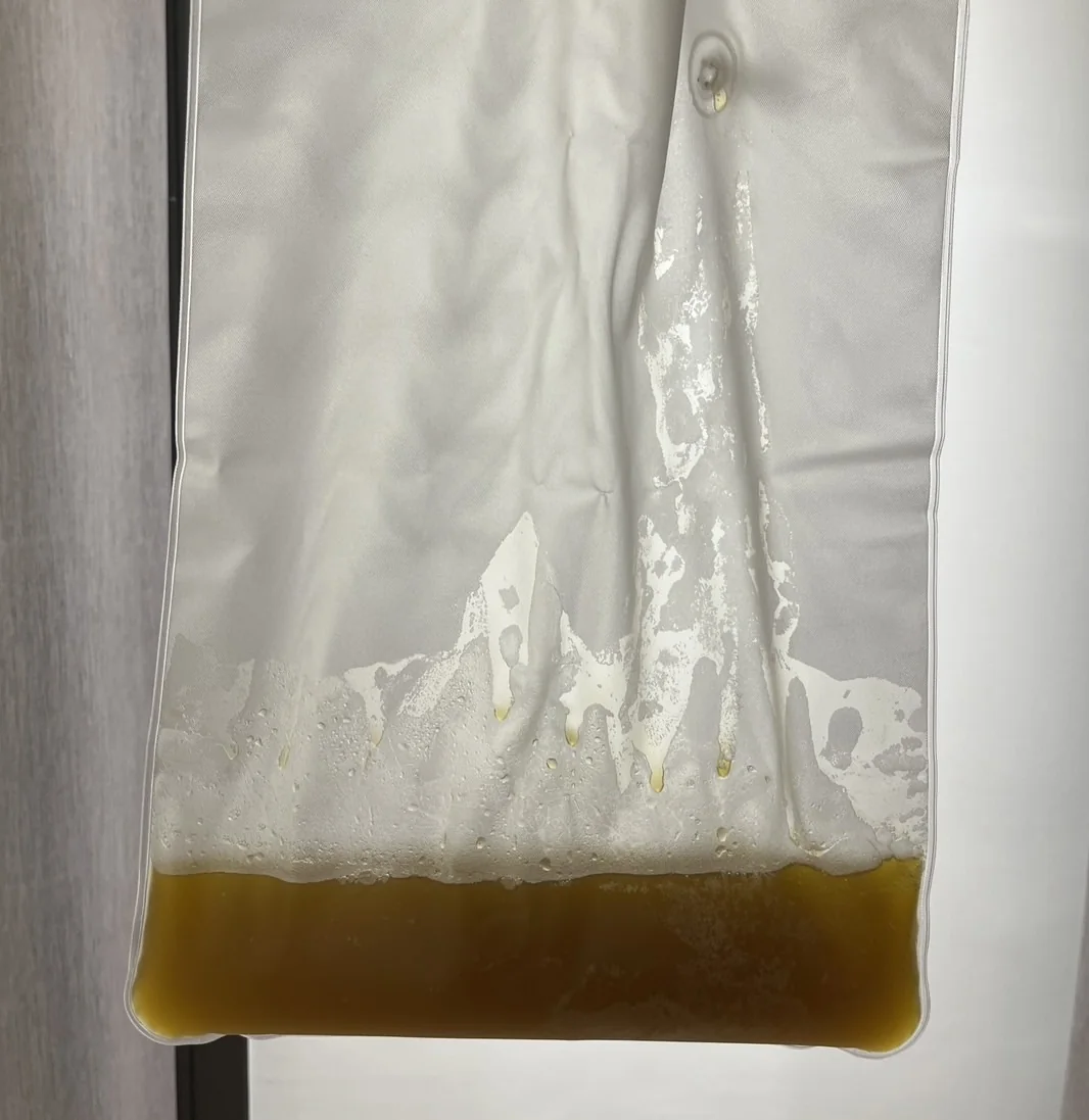 A hanging plasma collection bag with a dense olive-amber layer at the bottom and pale foamy residue on the walls above